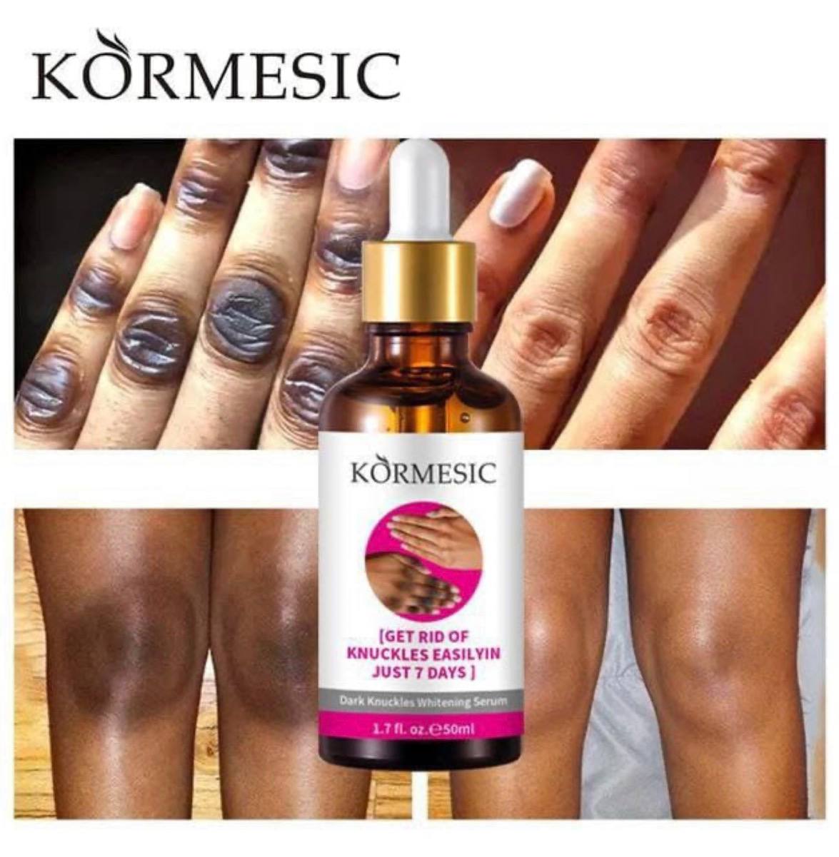 Sérum KORMESIC: Dites adieu aux Taches Rebelles, kinto, genoux, coudes noirs (2 ACHETE=1 OFFERT Traitement complet)🇨🇲